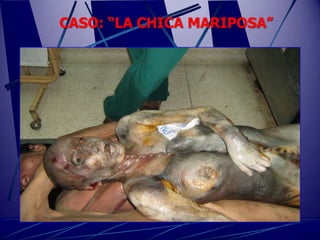 CASO: “LA CHICA MARIPOSA”
 