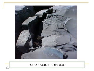 MSM
SEPARACION HOMBRO
 