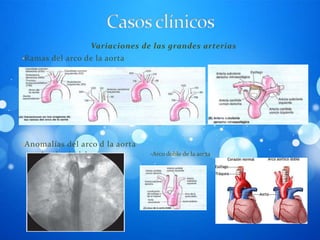 Variaciones de las grandes arterias
•Ramas del arco de la aorta




•Anomalías del arco d la aorta
    -Arco derecho de la aorta        -Arco doble de la aorta
 