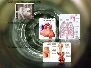  Aneurisma de la aorta ascendente




 Coartación de la aorta




 Lesión de los nervios laríngeos
 