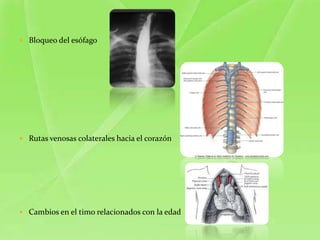  Bloqueo del esófago




 Rutas venosas colaterales hacia el corazón




 Cambios en el timo relacionados con la edad
 