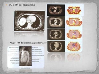  TC Y RM del mediastino




  -Angio- RM del corazón y grandes vasos
 