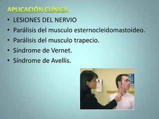 •   LESIONES DEL NERVIO
•   Parálisis del musculo esternocleidomastoideo.
•   Parálisis del musculo trapecio.
•   Síndrome de Vernet.
•   Síndrome de Avellis.
 