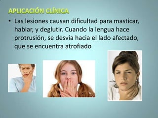 • Las lesiones causan dificultad para masticar,
  hablar, y deglutir. Cuando la lengua hace
  protrusión, se desvía hacia el lado afectado,
  que se encuentra atrofiado
 