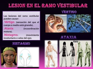 Las lesiones del ramo vestibular
pueden causar:
.Vértigo: (sensación del que el
cuerpo o medio está girando).
.Ataxia:           (incoordinación
motora).
.Nistagmo:             (movimiento
involuntario o veloz del ojo).
 