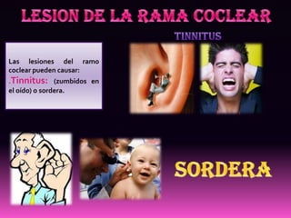 Las lesiones del ramo
coclear pueden causar:
.Tinnitus: (zumbidos en
el oído) o sordera.
 