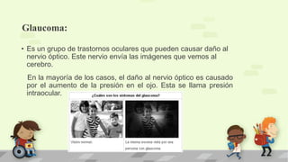 Glaucoma:
• Es un grupo de trastornos oculares que pueden causar daño al
nervio óptico. Este nervio envía las imágenes que vemos al
cerebro.
En la mayoría de los casos, el daño al nervio óptico es causado
por el aumento de la presión en el ojo. Esta se llama presión
intraocular.
 