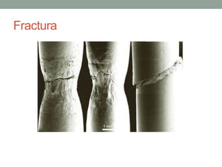 Fractura
 