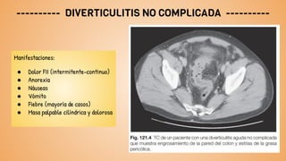 ---------- DIVERTICULITIS NO COMPLICADA ----------
Manifestaciones:
● Dolor FII (intermitente-continuo)
● Anorexia
● Náuseas
● Vómito
● Fiebre (mayoría de casos)
● Masa palpable cilíndrica y dolorosa
 