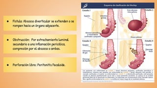 ● Fístula: Absceso diverticular se extienden o se
rompen hacia un órgano adyacente.
● Perforación libre: Peritonitis Fecaloide.
● Obstrucción: Por estrechamiento luminal
secundario a una inflamación pericólica,
compresión por el absceso o ambas.
 