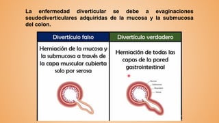 La enfermedad diverticular se debe a evaginaciones
seudodiverticulares adquiridas de la mucosa y la submucosa
del colon.
 