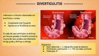 ------------- DIVERTICULITIS -------------
Inflamación o infección relacionadas con
divertículos, o ambas.
● Complicación más frecuente
● Aparece en un 10-25% de los casos
El cuello del saco ventricular se obstruye
por heceses pesadas; el fecalito erosiona la
mucosa del saco, produce una inflamación
de bajo grado y obstruye su drenaje
Diagnóstico:
● Dolor abdominal ---> radiografía simple de abdomen
● Perforación u obstrucción ---> TAC con doble contraste
● Endoscopia ✘
 