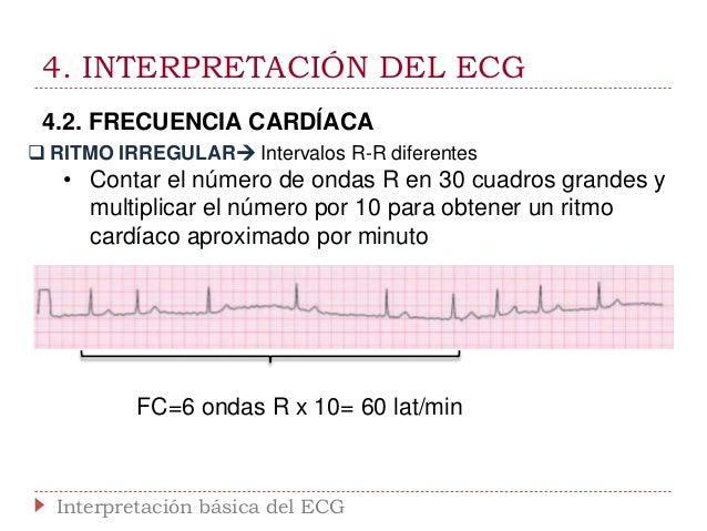 Interpretación básica del ECG