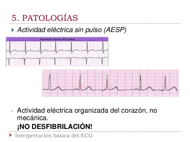 Interpretación básica del ECG