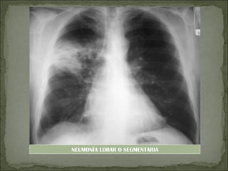 NEUMONÍA LOBAR O SEGMENTARIA
 