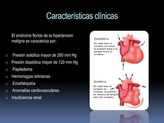 Características clínicas
    El síndrome florido de la hipertensión
    maligna se caracteriza por:


o   Presión sistólica mayor de 200 mm Hg
o Presión diastólica mayor de 120 mm Hg
o   Papiledema
o Hemorragias retinianas
o   Encefalopatía
o   Anomalías cardiovasculares
o Insuficiencia renal
 