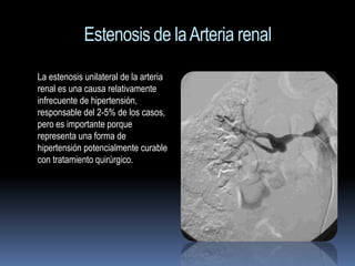 Estenosis de la Arteria renal
La estenosis unilateral de la arteria
renal es una causa relativamente
infrecuente de hipertensión,
responsable del 2-5% de los casos,
pero es importante porque
representa una forma de
hipertensión potencialmente curable
con tratamiento quirúrgico.
 