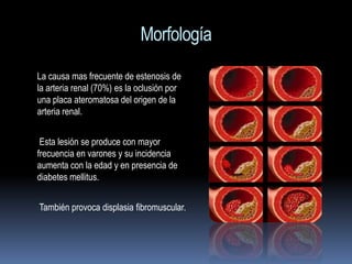 Morfología
La causa mas frecuente de estenosis de
la arteria renal (70%) es la oclusión por
una placa ateromatosa del origen de la
arteria renal.


 Esta lesión se produce con mayor
frecuencia en varones y su incidencia
aumenta con la edad y en presencia de
diabetes mellitus.


También provoca displasia fibromuscular.
 