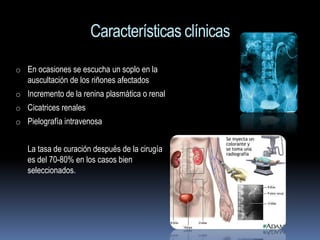 Características clínicas
o En ocasiones se escucha un soplo en la
   auscultación de los riñones afectados
o Incremento de la renina plasmática o renal
o Cicatrices renales
o Pielografía intravenosa


   La tasa de curación después de la cirugía
   es del 70-80% en los casos bien
   seleccionados.
 