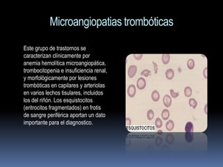 Microangiopatias trombóticas
Este grupo de trastornos se
caracterizan clínicamente por
anemia hemolítica microangiopática,
trombocitopenia e insuficiencia renal,
y morfológicamente por lesiones
trombóticas en capilares y arteriolas
en varios lechos tisulares, incluidos
los del riñón. Los esquistocitos
(eritrocitos fragmentados) en frotis
de sangre periférica aportan un dato
importante para el diagnostico.
 