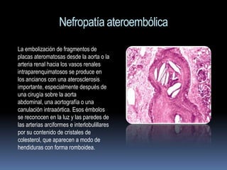 Nefropatía ateroembólica
La embolización de fragmentos de
placas ateromatosas desde la aorta o la
arteria renal hacia los vasos renales
intraparenquimatosos se produce en
los ancianos con una aterosclerosis
importante, especialmente después de
una cirugía sobre la aorta
abdominal, una aortografía o una
canulación intraaórtica. Esos émbolos
se reconocen en la luz y las paredes de
las arterias arciformes e interlobulillares
por su contenido de cristales de
colesterol, que aparecen a modo de
hendiduras con forma romboidea.
 