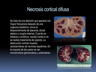 Necrosis cortical difusa
Se trata de una afección que aparece con
mayor frecuencia después de una
urgencia obstétrica, como el
desprendimiento de placenta, shock
séptico o cirugía extensa. Cuando es
bilateral y simétrica, resulta mortal si no
se realiza tratamiento de soporte. La
destrucción cortical muestra
características de necrosis isquémica. En
la mayoría de los casos se ven
microtrombos glomerulares y arteriolares.
 