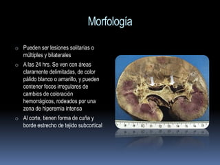 Morfología
o Pueden ser lesiones solitarias o
   múltiples y bilaterales
o A las 24 hrs. Se ven con áreas
   claramente delimitadas, de color
   pálido blanco o amarillo, y pueden
   contener focos irregulares de
   cambios de coloración
   hemorrágicos, rodeados por una
   zona de hiperemia intensa
o Al corte, tienen forma de cuña y
   borde estrecho de tejido subcortical
 