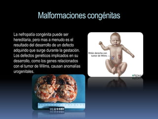 Malformaciones congénitas
La nefropatía congénita puede ser
hereditaria, pero mas a menudo es el
resultado del desarrollo de un defecto
adquirido que surge durante la gestación.
Los defectos genéticos implicados en su
desarrollo, como los genes relacionados
con el tumor de Wilms, causan anomalías
urogenitales.
 