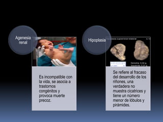 Agenesia
                                  Hipoplasia
  renal




                                               Se refiere al fracaso
           Es incompatible con                 del desarrollo de los
           la vida, se asocia a                riñones, una
           trastornos                          verdadera no
           congénitos y                        muestra cicatrices y
           provoca muerte                      tiene un número
           precoz.                             menor de lóbulos y
                                               pirámides.
 