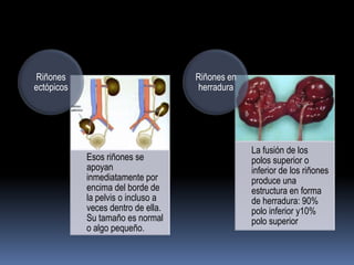 Riñones                             Riñones en
ectópicos                           herradura




                                                 La fusión de los
            Esos riñones se                      polos superior o
            apoyan                               inferior de los riñones
            inmediatamente por                   produce una
            encima del borde de                  estructura en forma
            la pelvis o incluso a                de herradura: 90%
            veces dentro de ella.                polo inferior y10%
            Su tamaño es normal                  polo superior
            o algo pequeño.
 