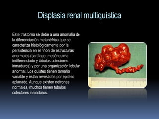 Displasia renal multiquística
Este trastorno se debe a una anomalía de
la diferenciación metanéfrica que se
caracteriza histológicamente por la
persistencia en el riñón de estructuras
anormales (cartílago, mesénquima
indiferenciado y túbulos colectores
inmaduros) y por una organización lobular
anormal. Los quistes tienen tamaño
variable y están revestidos por epitelio
aplanado. Aunque existen nefronas
normales, muchos tienen túbulos
colectores inmaduros.
 