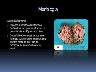 Morfología
Macroscópicamente
o Riñones aumentados de tamaño
   bilateralmente y pueden alcanzar un
   peso de hasta 4 Kg en cada riñón
o Superficie externa que parece estar
   formada solamente por una masa de
   quistes hasta de 3 o 4 cm de
   diámetro, sin parénquima en su
   interior
 