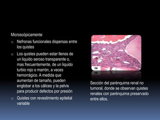 Microscópicamente
o Nefronas funcionales dispersas entre
   los quistes
o Los quistes pueden estar llenos de
   un liquido seroso transparente o,
   mas frecuentemente, de un liquido
   turbio rojo o marrón, a veces
   hemorrágico. A medida que
   aumentan de tamaño, pueden
                                         Sección del parénquima renal no
   englobar a los cálices y la pelvis
                                         tumoral, donde se observan quistes
   para producir defectos por presión
                                         renales con parénquima preservado
o Quistes con revestimiento epitelial    entre ellos.
   variable
 