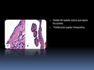 o Detalle del epitelio cúbico que tapiza
    los quistes.
o   Proliferación papilar intraquística.
 