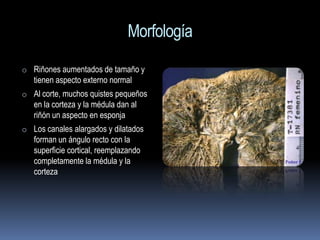 Morfología
o Riñones aumentados de tamaño y
   tienen aspecto externo normal
o Al corte, muchos quistes pequeños
   en la corteza y la médula dan al
   riñón un aspecto en esponja
o Los canales alargados y dilatados
   forman un ángulo recto con la
   superficie cortical, reemplazando
   completamente la médula y la
   corteza
 