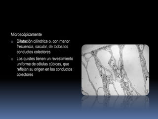 Microscópicamente
o Dilatación cilíndrica o, con menor
   frecuencia, sacular, de todos los
   conductos colectores
o Los quistes tienen un revestimiento
   uniforme de células cúbicas, que
   reflejan su origen en los conductos
   colectores
 