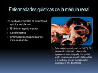 Enfermedades quísticas de la médula renal
Los tres tipos principales de enfermedad
   quística medular son:
o El riñón en esponja medular
o La nefronoptisis
o Enfermedad quística medular de
   inicio en el adulto

                                           Enfermedad quística medular (MCD). El
                                           corte está conservado y la medula
                                           aparece un tanto apagada. Los quistes
                                           están presentes en la unión de la corteza
                                           y la medula y en este ejemplo miden
                                           encima de 4 cm. de diámetro
 