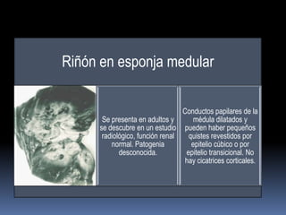 Riñón en esponja medular

                                 Conductos papilares de la
      Se presenta en adultos y      médula dilatados y
     se descubre en un estudio pueden haber pequeños
      radiológico, función renal   quistes revestidos por
         normal. Patogenia          epitelio cúbico o por
            desconocida.          epitelio transicional. No
                                  hay cicatrices corticales.
 