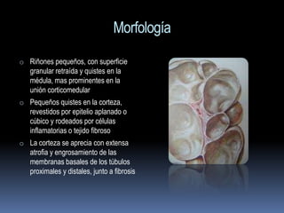 Morfología
o Riñones pequeños, con superficie
   granular retraída y quistes en la
   médula, mas prominentes en la
   unión corticomedular
o Pequeños quistes en la corteza,
   revestidos por epitelio aplanado o
   cúbico y rodeados por células
   inflamatorias o tejido fibroso
o La corteza se aprecia con extensa
   atrofia y engrosamiento de las
   membranas basales de los túbulos
   proximales y distales, junto a fibrosis
 