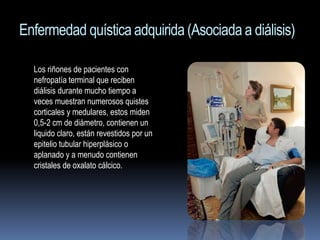 Enfermedad quística adquirida (Asociada a diálisis)

  Los riñones de pacientes con
  nefropatía terminal que reciben
  diálisis durante mucho tiempo a
  veces muestran numerosos quistes
  corticales y medulares, estos miden
  0,5-2 cm de diámetro, contienen un
  liquido claro, están revestidos por un
  epitelio tubular hiperplásico o
  aplanado y a menudo contienen
  cristales de oxalato cálcico.
 