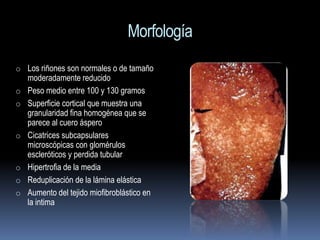 Morfología
o Los riñones son normales o de tamaño
    moderadamente reducido
o   Peso medio entre 100 y 130 gramos
o   Superficie cortical que muestra una
    granularidad fina homogénea que se
    parece al cuero áspero
o   Cicatrices subcapsulares
    microscópicas con glomérulos
    escleróticos y perdida tubular
o   Hipertrofia de la media
o   Reduplicación de la lámina elástica
o   Aumento del tejido miofibroblástico en
    la intima
 