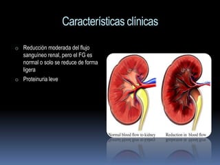 Características clínicas
o Reducción moderada del flujo
   sanguíneo renal, pero el FG es
   normal o solo se reduce de forma
   ligera
o Proteinuria leve
 