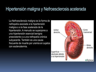 Hipertensión maligna y Nefroesclerosis acelerada

 La Nefroesclerosis maligna es la forma de
 nefropatía asociada a la hipertensión
 maligna o a la fase acelerada de la
 hipertensión. A menudo se superpone a
 una hipertensión esencial benigna
 preexistente o a una nefropatía crónica
 subyacente. También es una causa
 frecuente de muerte por uremia en sujetos
 con esclerodermia.
 