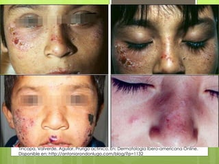 Tincopa, Valverde, Aguilar. Prurigo actínico. En: Dermatologia Ibero-americana Online.
Disponible en: http://antoniorondonlugo.com/blog/?p=1132
 
