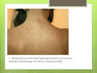  Residual brown reticulate hyperpigmentation on the back.
Pediatric Dermatology Vol. 24 No. 3 May/June 2007
 