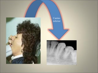 Canino inferior 