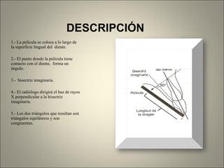DESCRIPCIÓN 1.- La película se coloca a lo largo de la superficie lingual del  diente. 2.- El punto donde la película tiene contacto con el diente,  forma un ángulo. 3.-  bisectriz imaginaria. 4.- El radiólogo dirigirá el haz de rayos X perpendicular a la bisectriz imaginaria. 5.- Los dos triángulos que resultan son triángulos equiláteros y son congruentes.  