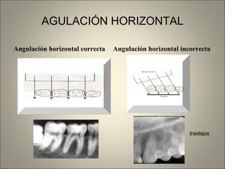 AGULACIÓN HORIZONTAL Angulación horizontal correcta Angulación horizontal incorrecta traslape 