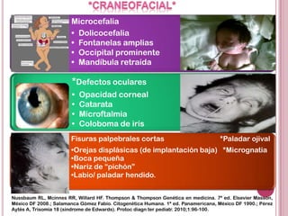 Microcefalia
                       • Dolicocefalia
                       • Fontanelas amplias
                       • Occipital prominente
                       • Mandíbula retraída

                        *Defectos oculares
                        •   Opacidad corneal
                        •   Catarata
                        •   Microftalmia
                        •   Coloboma de iris
                       Fisuras palpebrales cortas                                 *Paladar ojival
                       •Orejas displásicas (de implantación baja) *Micrognatia
                       •Boca pequeña
                       •Nariz de “pichón”
                       •Labio/ paladar hendido.


Nussbaum RL, Mcinnes RR, Willard HF. Thompson & Thompson Genética en medicina. 7ª ed. Elsevier Masson,
México DF 2008.; Salamanca Gómez Fabio. Citogenética Humana. 1ª ed. Panamericana, México DF 1990.; Pérez
Aytés A, Trisomía 18 (síndrome de Edwards). Protoc diagn ter pediatr. 2010;1:96-100.
 