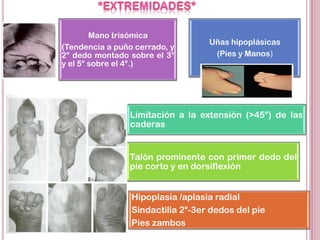Mano trisómica
                                   Uñas hipoplásicas
(Tendencia a puño cerrado, y
2° dedo montado sobre el 3°         (Pies y Manos)
y el 5° sobre el 4°.)




                Limitación a la extensión (>45°) de las
                caderas


                Talón prominente con primer dedo del
                pie corto y en dorsiflexión


                 Hipoplasia /aplasia radial
                 Sindactilia 2°-3er dedos del pie
                 Pies zambos
 